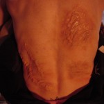 KB Back scar
